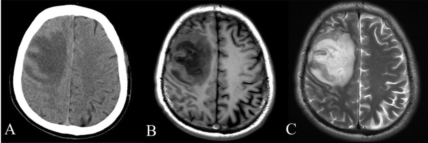 Studi Terbaru: Obat Ozempic Turunkan Risiko Demensia Alzheimer Hingga 40 Persen